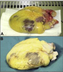 Un nuevo paso en el camino hacia la creación de órganos. Corazón antes (A) y después (B) de quitarle las células. Imagen modificada del artículo.