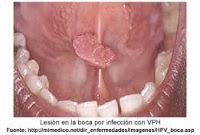 El VPH Induce Cancer de Cabeza y Cuello