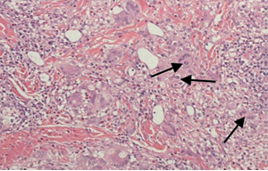 Blastomicosis