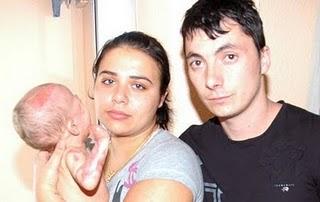 Cavadas reconstruirá los brazos de un bebé afectado por meningitis Cavadas reconstruirá los brazos de un bebé afectado por meningitis