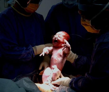 Transferir parte de los beneficios de un parto vaginal a un parto por cesárea Microbiota durante el parto