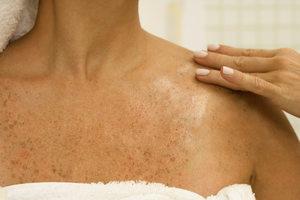 ¿La vitamina E ayuda a eliminar las manchas oscuras de la piel?