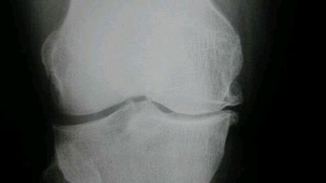 ¿Correr es malo para las rodillas? artrosis_rodilla