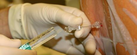 Una punción lumbar para detectar tumores cerebrales Una punción lumbar para detectar tumores cerebrales