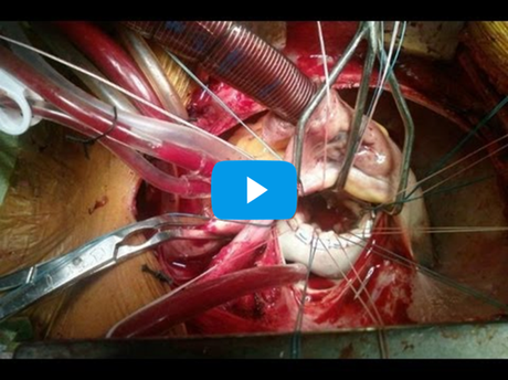 Tratar la enfermedad #cardíaca con Frutas y Verduras Tratar la enfermedad #cardíaca con Frutas y Verduras