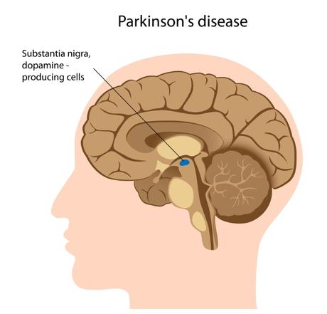 Enfermedad de Parkinson: causas, síntomas y tratamiento