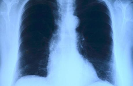 Un algoritmo matemático, clave para prevenir el cáncer de pulmón