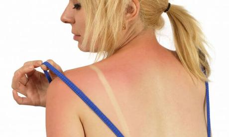 Aprende como aliviar las quemaduras solares: Aprende como aliviar las quemaduras solares: