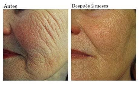 Profound La Última Revelación en Radiofrecuencia Facial de Syneron Candela Profound La Última Revelación en Radiofrecuencia Facial de Syneron Candela