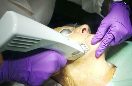 Profound La Última Revelación en Radiofrecuencia Facial de Syneron Candela Profound La Última Revelación en Radiofrecuencia Facial de Syneron Candela