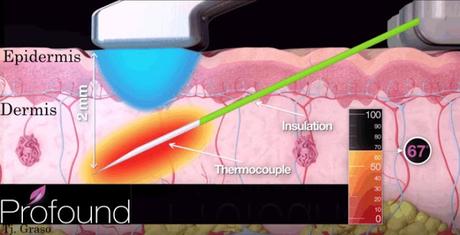 Profound La Última Revelación en Radiofrecuencia Facial de Syneron Candela Profound La Última Revelación en Radiofrecuencia Facial de Syneron Candela