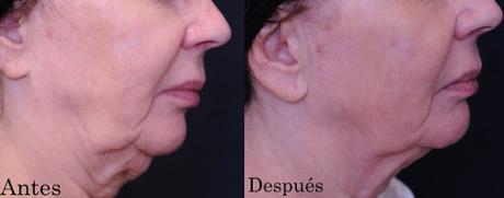 Profound La Última Revelación en Radiofrecuencia Facial de Syneron Candela Profound La Última Revelación en Radiofrecuencia Facial de Syneron Candela