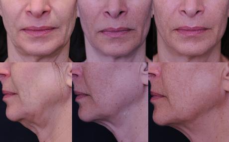 Profound La Última Revelación en Radiofrecuencia Facial de Syneron Candela Profound La Última Revelación en Radiofrecuencia Facial de Syneron Candela