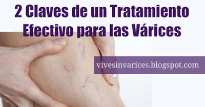Claves de un Tratamiento efectivo para las Varices Claves de un Tratamiento efectivo para las Varices