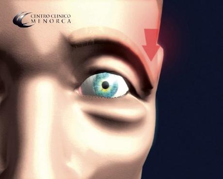 La Blefaroplastia en la Eliminación de las Bolsas del Contorno de los Ojos La Blefaroplastia en la Eliminación de las Bolsas del Contorno de los Ojos
