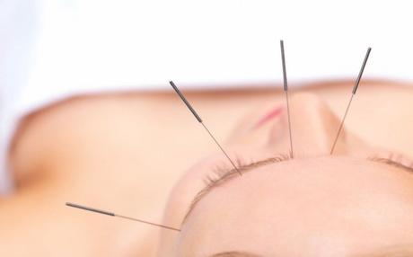 Método de acupuntura Berkley para prevenir el aborto Involuntario