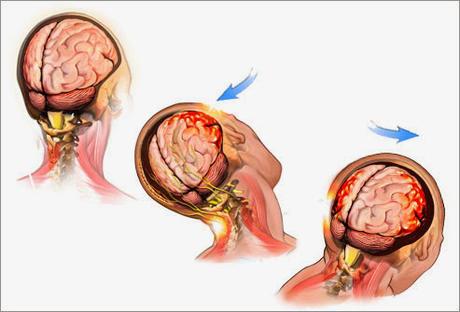 conmocion-cerebral