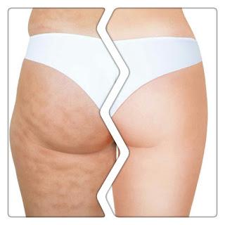 Anticelulíticos ¿funcionan ? Anticelulíticos ¿funcionan ?