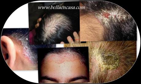 Enfermedades del cuero cabelludo y cabello !!