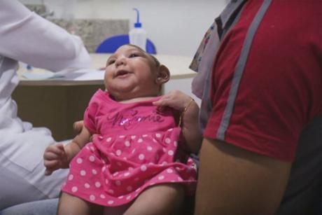 Cifras y datos de la microcefalia Microcefalia