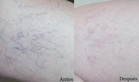 Eliminando las Arañas Vasculares en Cristina Álvarez Eliminando las Arañas Vasculares en Cristina Álvarez