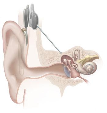 Cochlear implant.jpg
