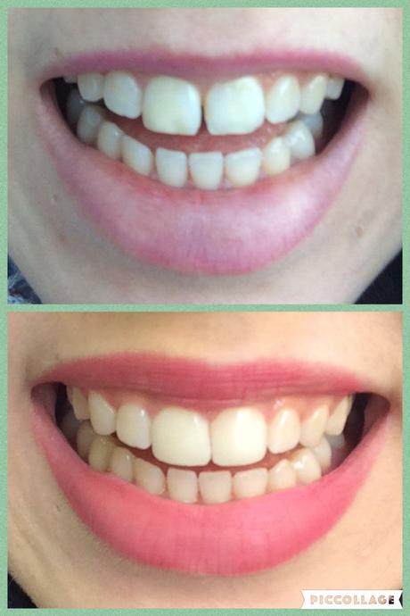 Carillas dentales de composite. Mi experiencia. PicCollage