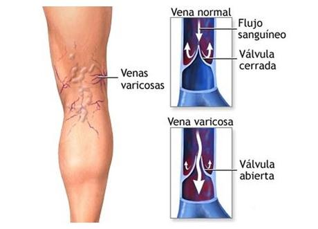 Consejos para reducir las varices Venas-varices-500x360