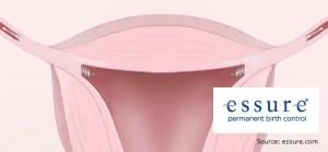 Essure bayer