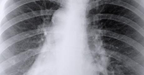 Pulmones estropeados y las segundas oportunidades