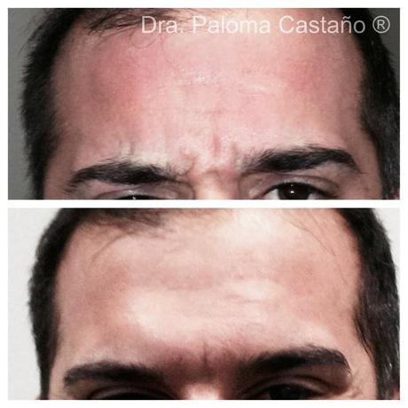 Dra. Paloma Castaño: Todo lo que siempre has querido saber sobre “Botox”.