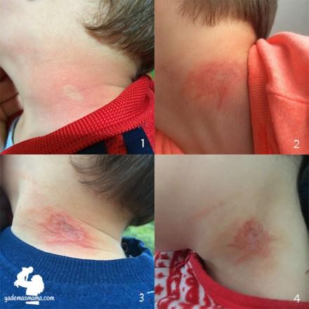 Manchas raras en primavera: la fitofotodermatitis fitofotodermatitis en el cuello