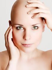 La caída del cabello durante la quimioterapia - Preguntas frecuentes