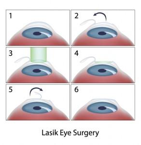 LASIK