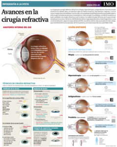 Cirugía refractiva