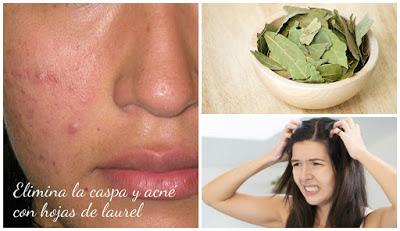 Beneficios de las hojas de laurel para eliminar la caspa y acné