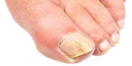 Onicólisis – Una condición donde las uñas se separan de la superficie de la piel espontáneamente Onicólisis