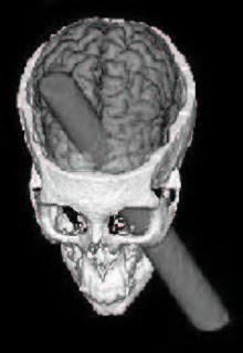 EL CURIOSO CASO DE PHINEAS GAGE