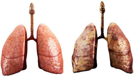 Riesgo de desarrollar cáncer de pulmón después de dejar de fumar Riesgo de desarrollar cáncer de pulmón después de dejar de fumar