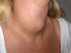 cuello con glándula tiroides aumentada