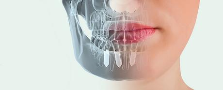 ¿Como cuidar tu salud dental? 11-Implantes