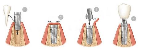 ¿Como cuidar tu salud dental? colocacion-implantes-dentales