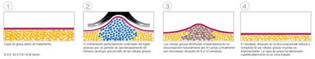 Todo lo que tienes que saber sobre la Criolipólisis. Sesión informativa en ICE Aesthetic criolipolisis-diagram_ICE72dpi