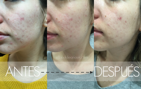 GLICOISDIN: Mi experiencia con el ácido glicólico GLICOISDIN: Mi experiencia con el ácido glicólico