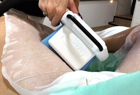 ¿Cómo funciona la Criolipólisis? Mi primer tratamiento en ICE Aesthetic Barcelona Cómo funciona la Criolipólisis