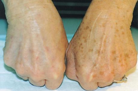 Con este remedio casero podrás blanquear las manchas en la piel Con este remedio casero podrás blanquear las manchas en la piel