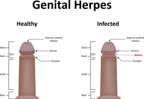 Die Operationen nach dem Ausschneiden der Hämorrhoide