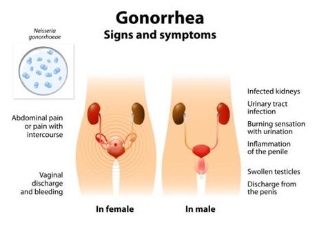 Infecciones de transmisión sexual