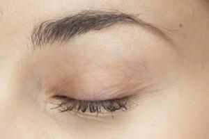 Parpado-cirugia-estetica Parpado cirugia estetica 300x200 Qué es el tic del párpado y cómo tratarlo