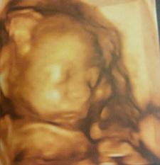 Seré bimadre: segundo trimestre de embarazo ecografia